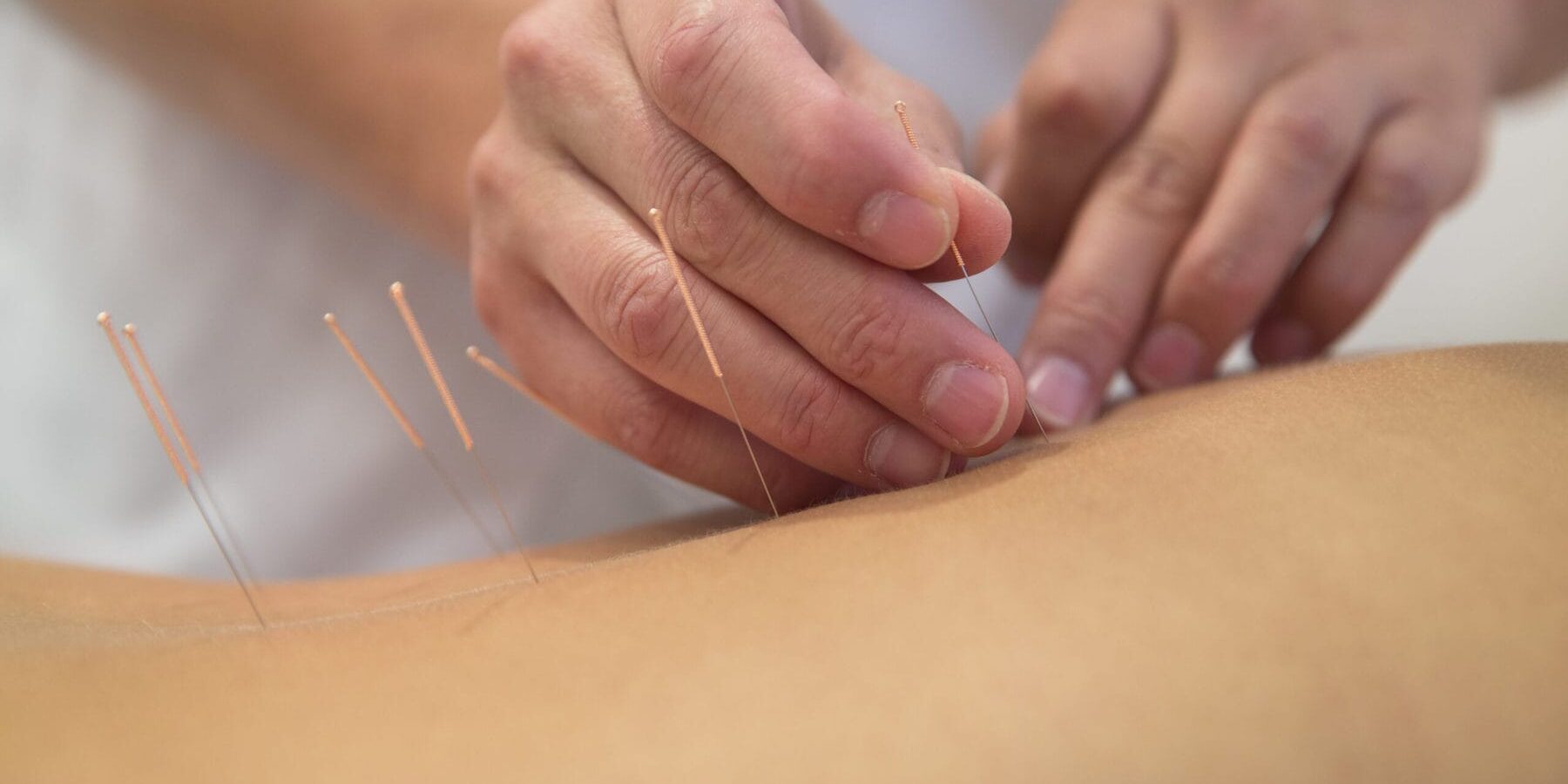 Acupuncture needles on back of a young woman